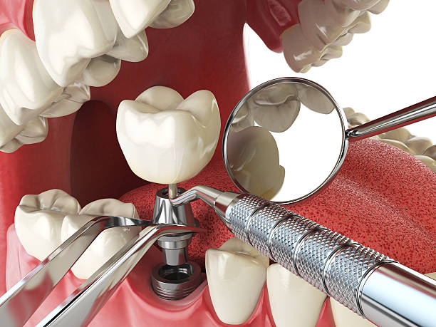 Best Emergency Treatment for Dental Infections or Abscesses in Easton, PA